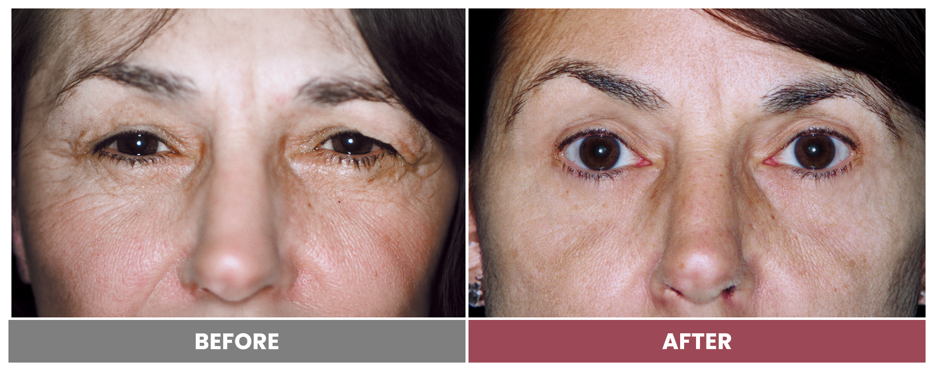 Upper Blepharoplasty - Case 79